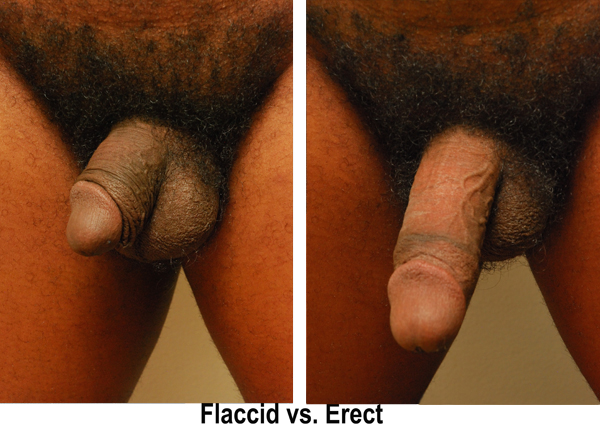 Flaccid Vs Erect Penis
